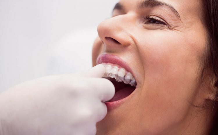  Allineatori dentali – La nuova frontiera del sorriso bello e sano